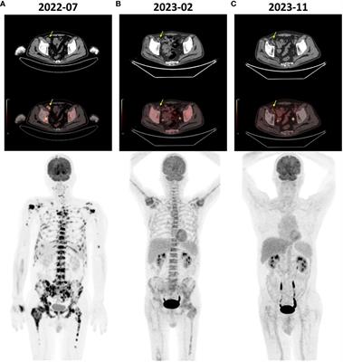 Case report: Immunotherapy-based combination therapy achieving complete remission and prolonged survival in nasopharyngeal carcinoma with extensive bone marrow metastasis